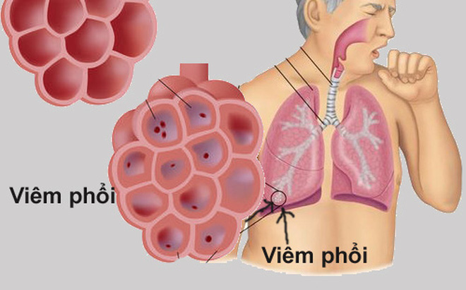 Bệnh viêm phổi là gì
